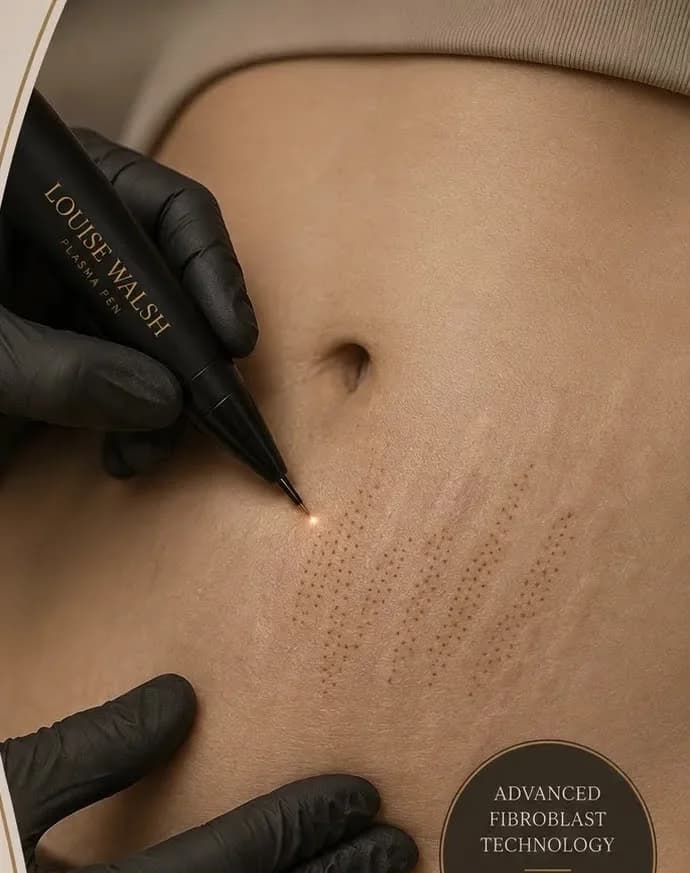 ELITE Renew™ Signature Plasma Stretch Mark Revision